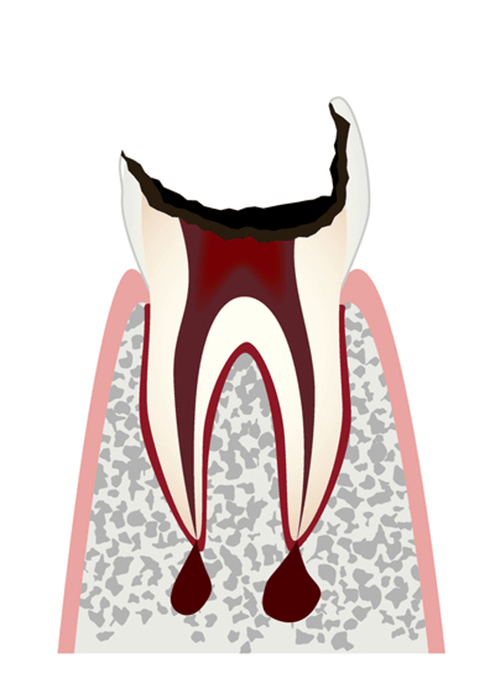 歯の根(歯質)が失われた歯