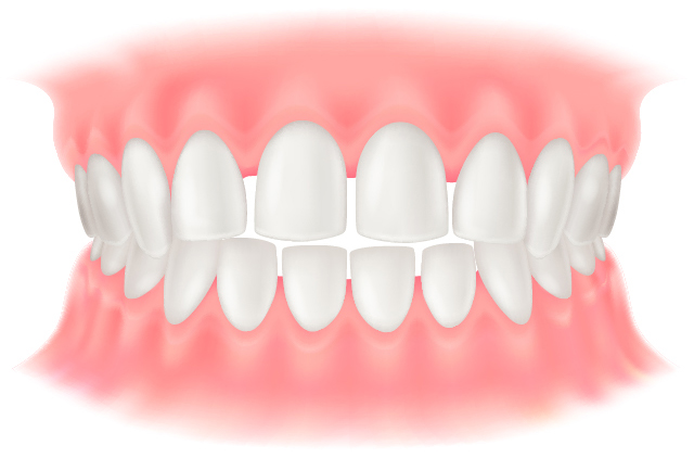 空隙歯列（くうげきしれつ）