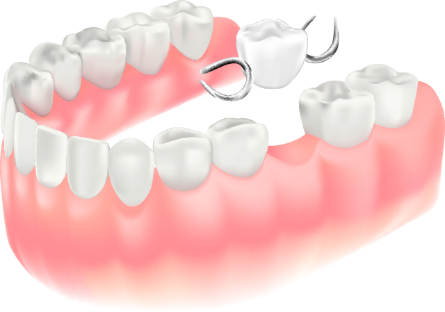 部分入れ歯